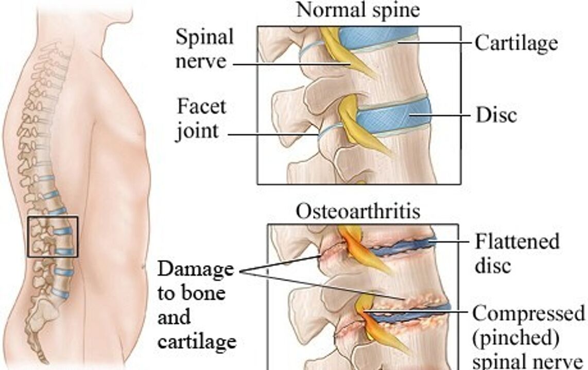 Der Unterschied zwischen einem gesunden Album und einem Album mit Osteochondrose