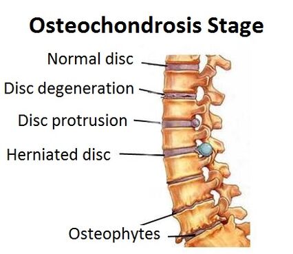 Osteochondrose -Stadien